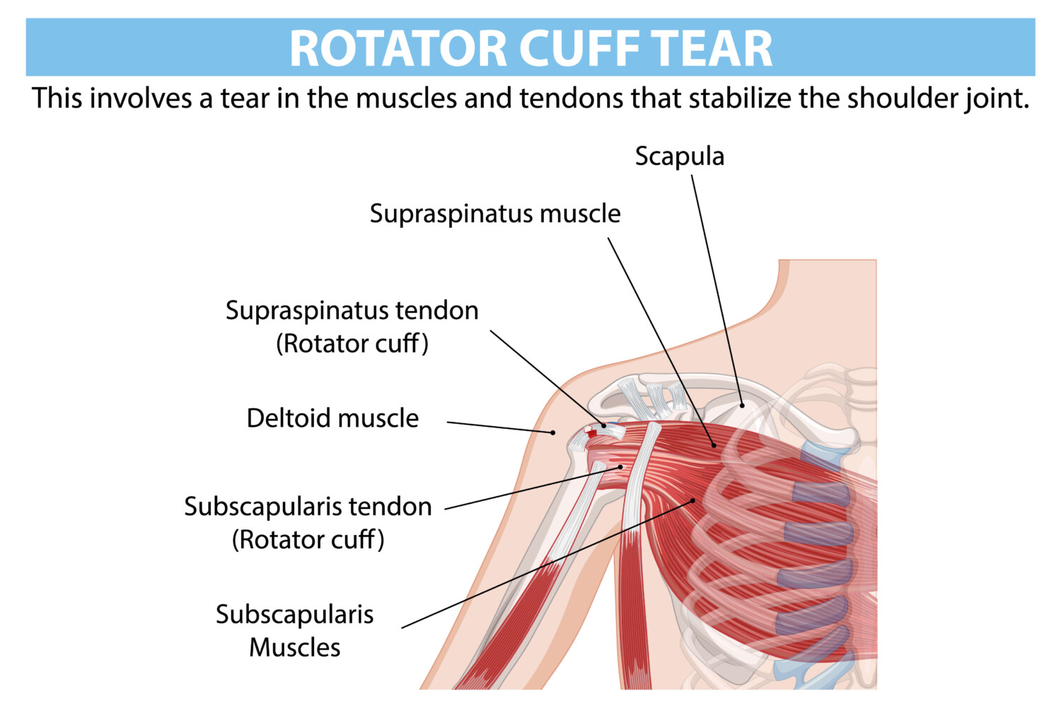 Rotator cuff -lihakset: Anatomia ja vaikutukset. Havainnollistava kuva rotator cuff -lihasten rakenteesta. Selittää supraspinatuksen ja subscapulariksen osuutta olkanivelen stabiloinnissa. Sopii oppimateriaaliksi terveysalan ammattilaisille ja kuntoutuksesta kiinnostuneille.